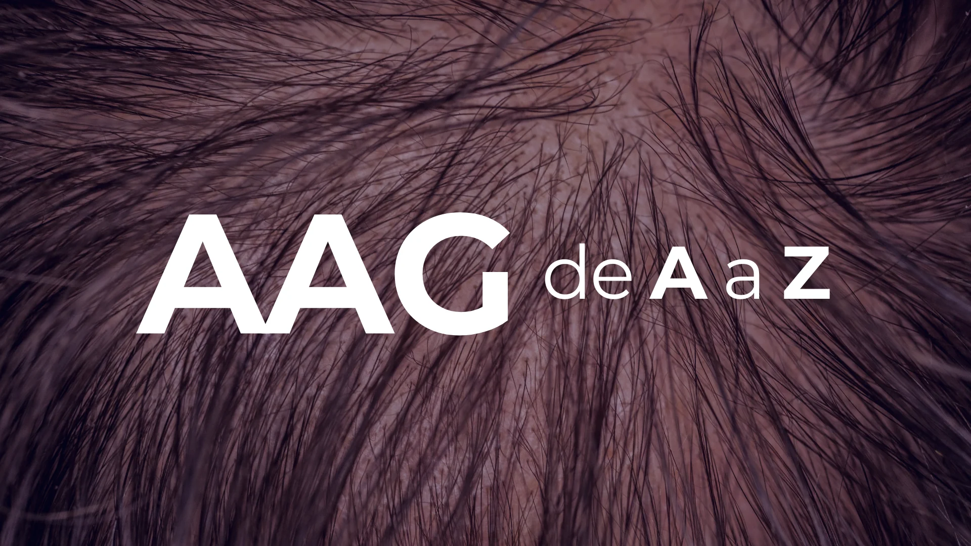 Alopecia Androgenética de A a Z