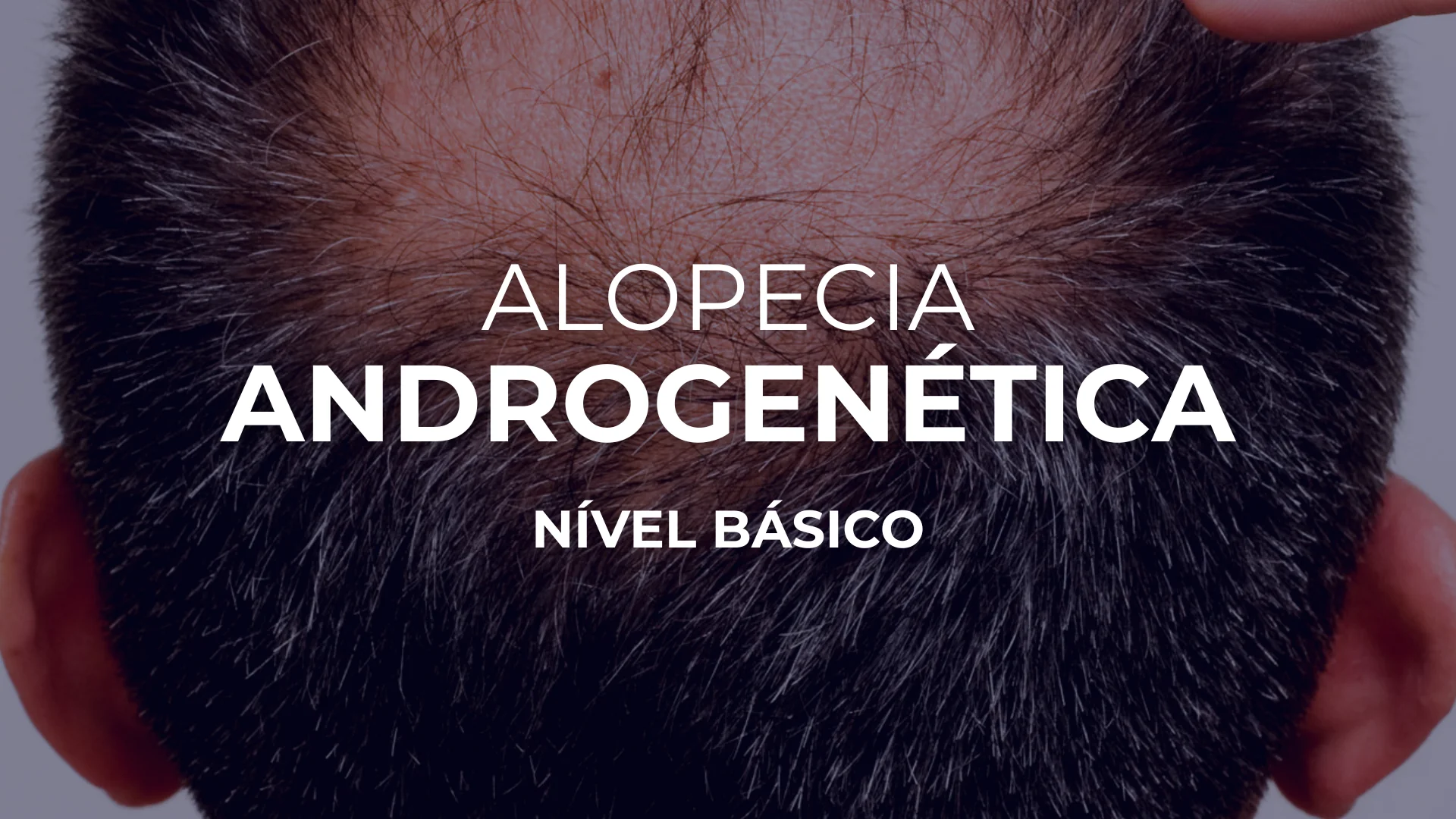 Alopecia Androgenética — Nível Básico