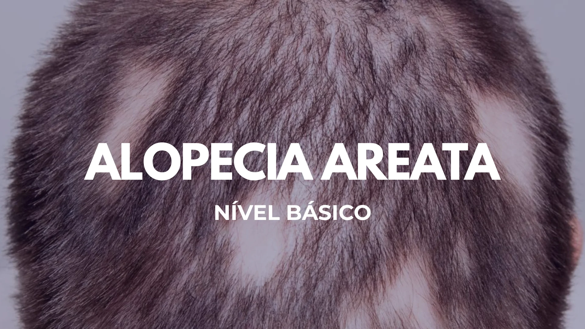 Alopecia Areata — Nível Básico