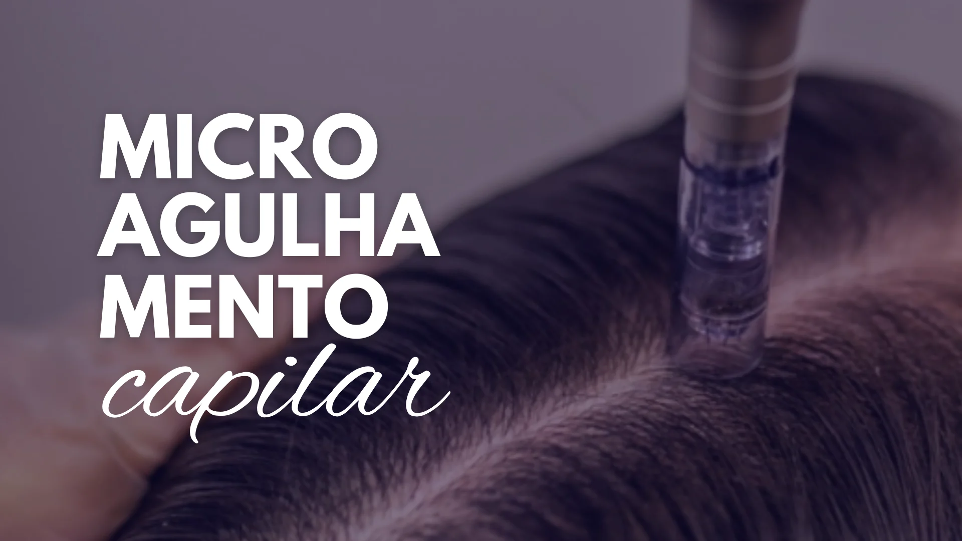 Microagulhamento Capilar