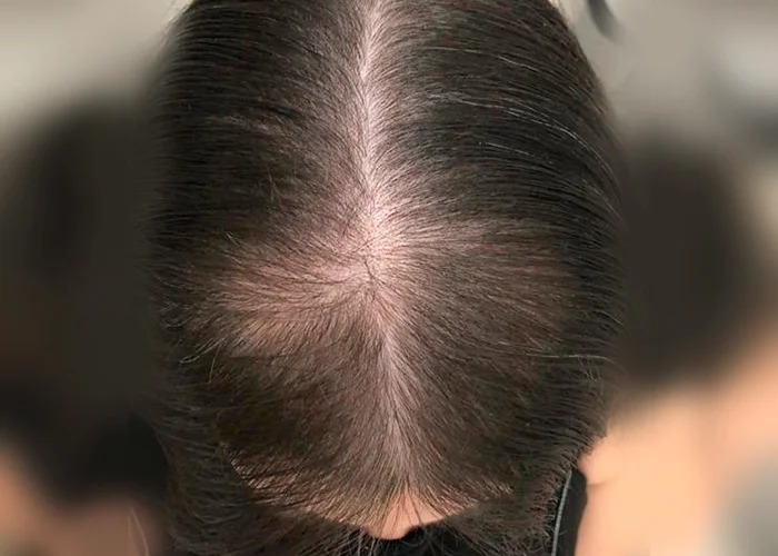 Alopecia Androgenética - AAG