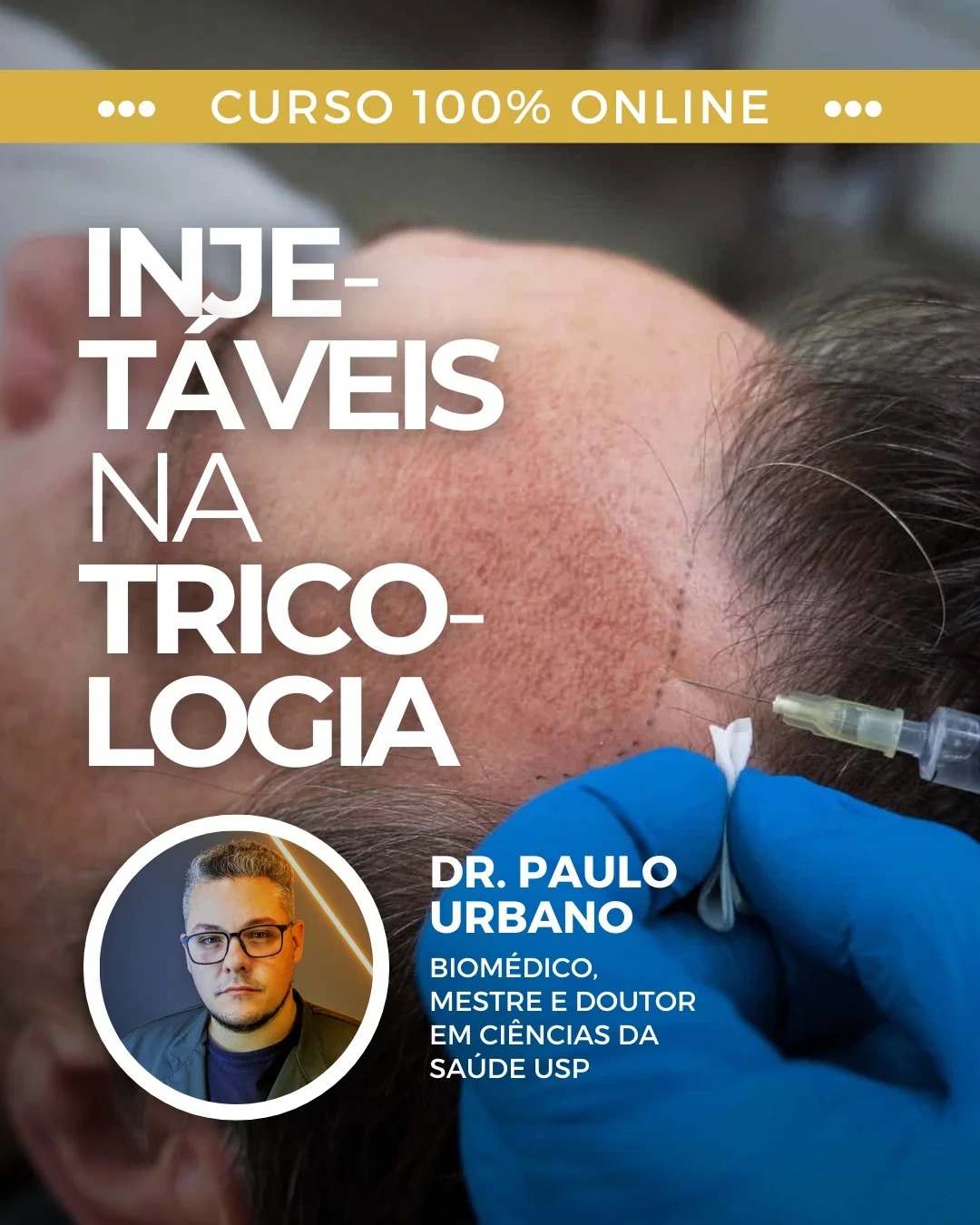 Microagulhamento Capilar