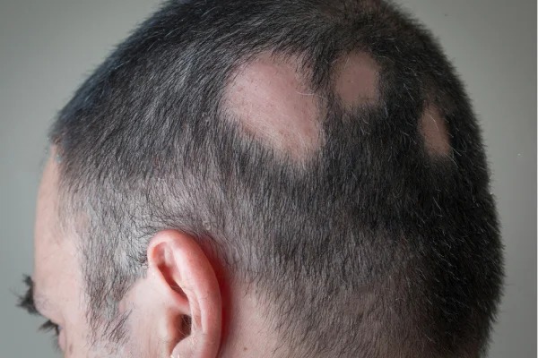 Microcorrentes na Terapia Capilar